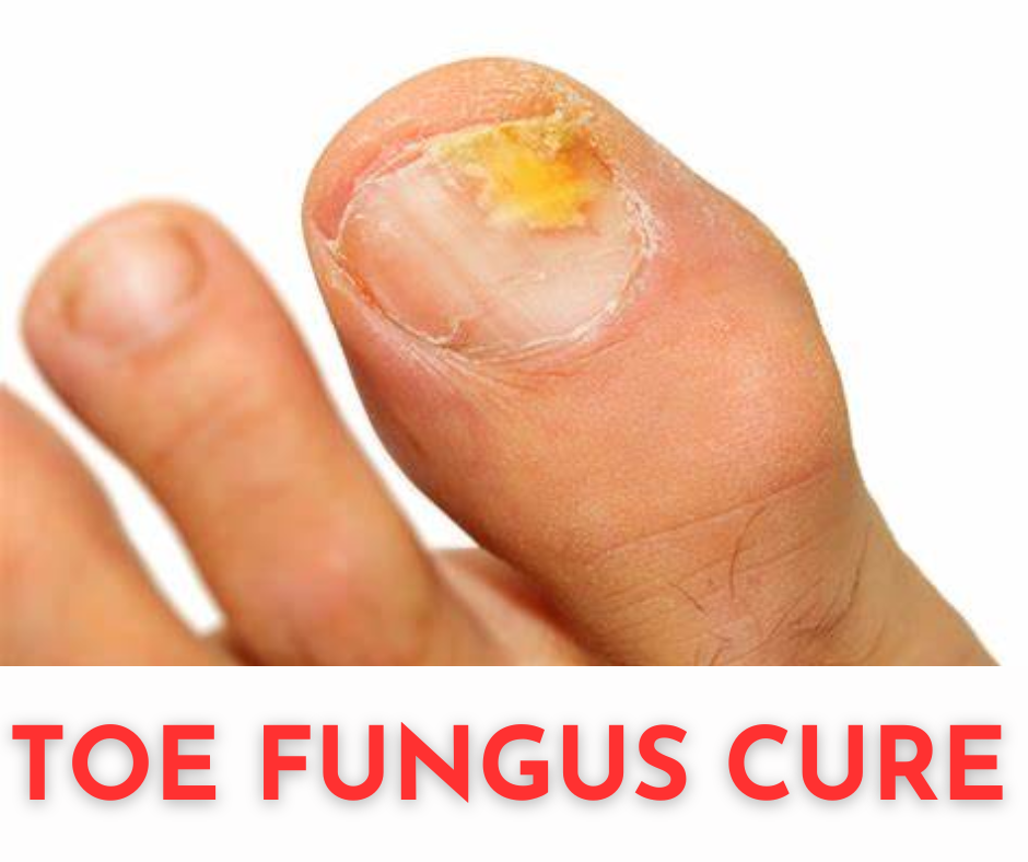 Toe Fungus Cure Toenail Fungus Expert 